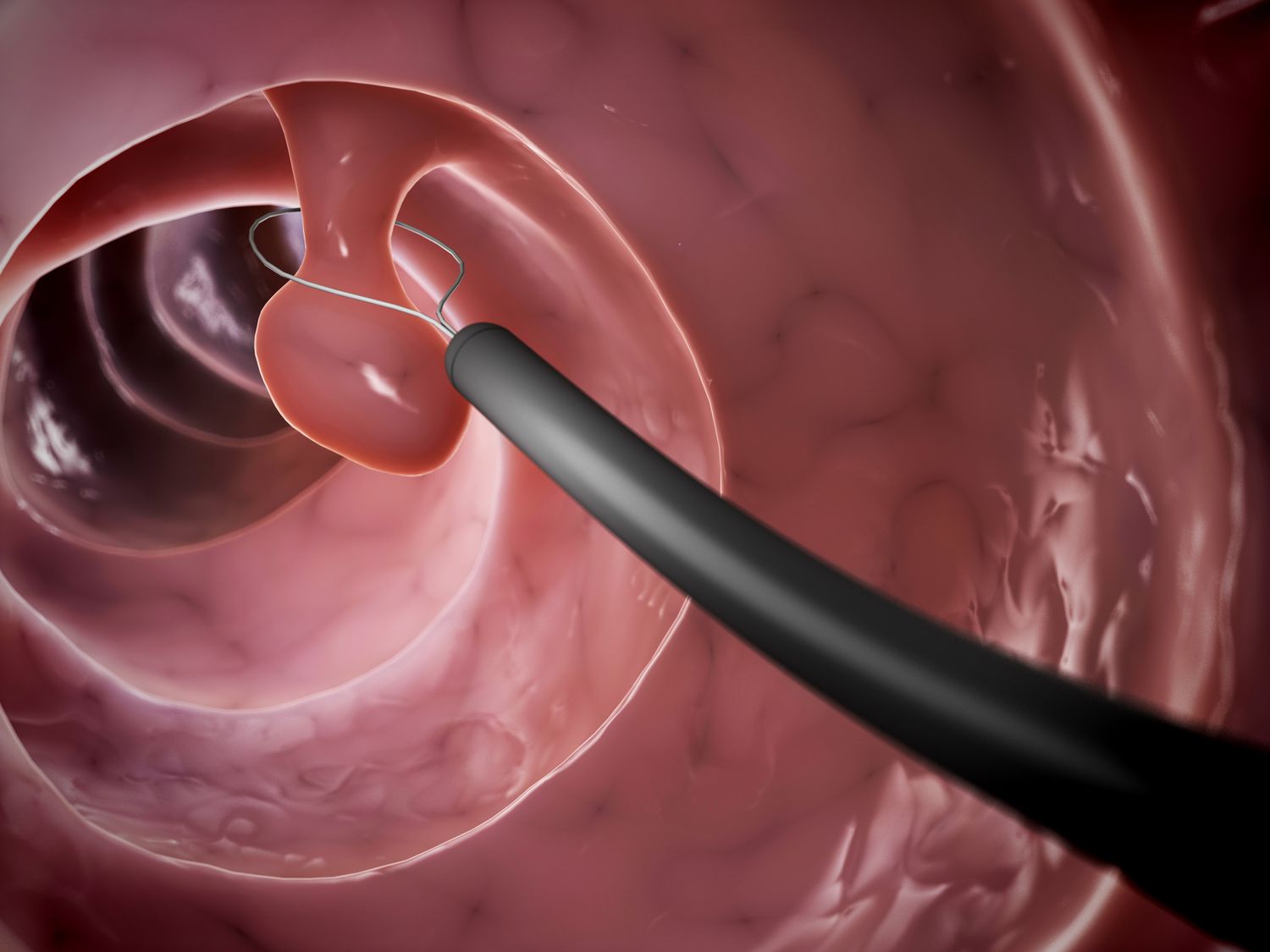 Segnali di Bisogno di Idroterapia